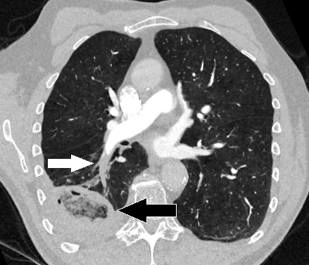 Infarto pulmonar