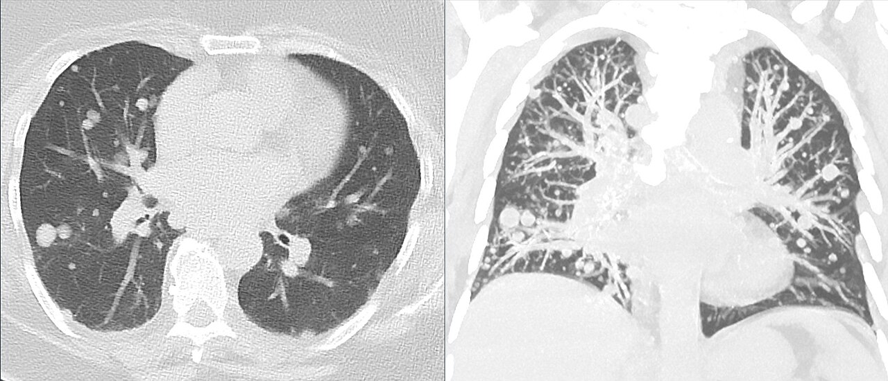 Metástasis pulmonares