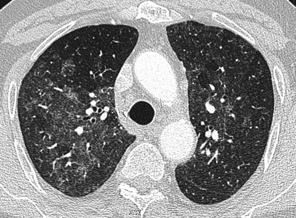 Neumonía por Pneumocystis jirovecii