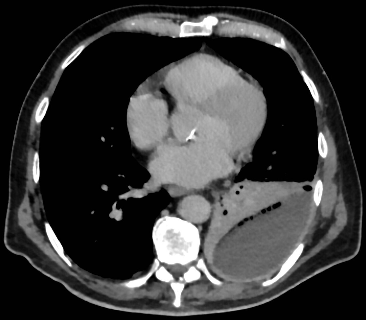 Empiema pleural