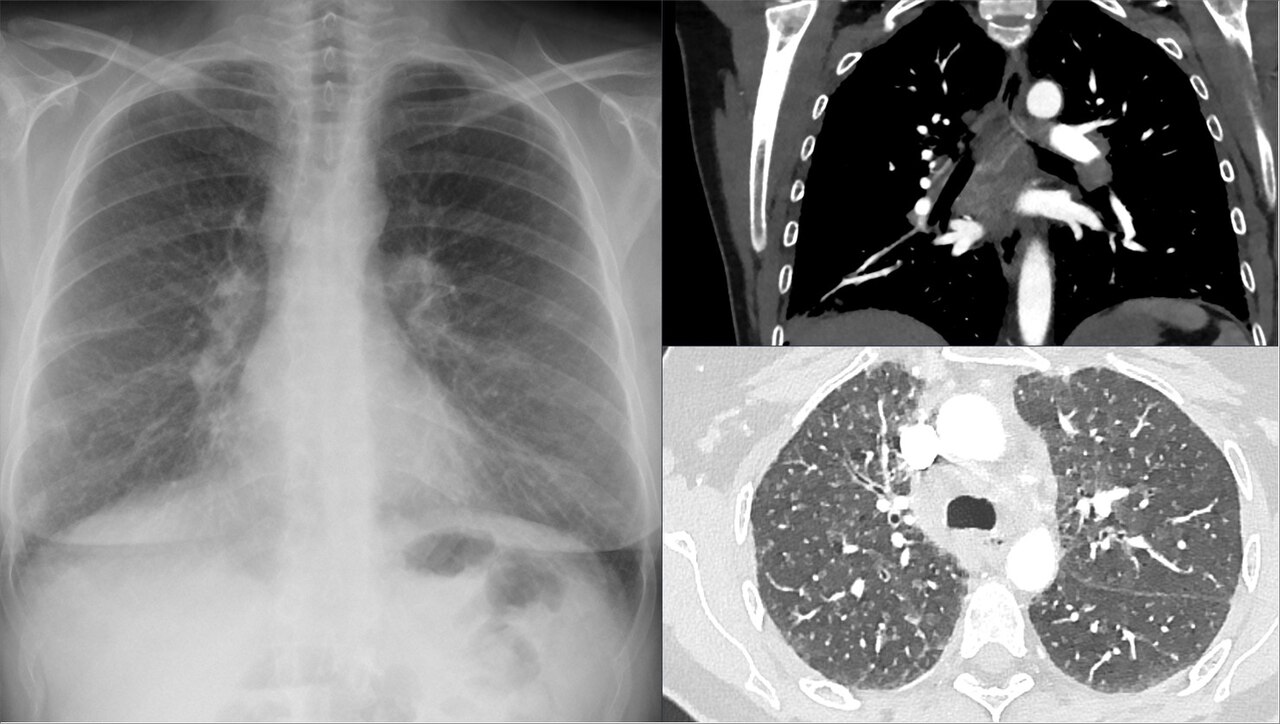 Sarcoidosis torácica