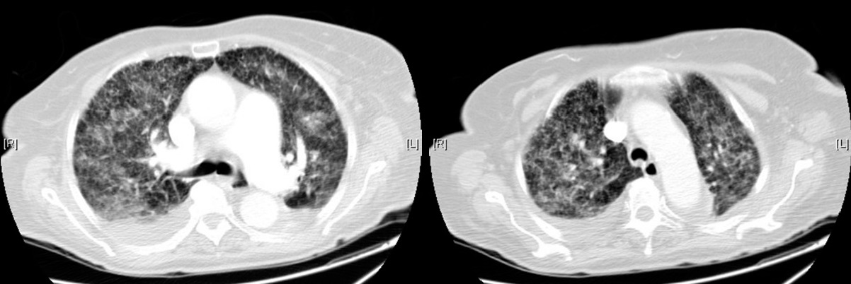 Tuberculosis miliar