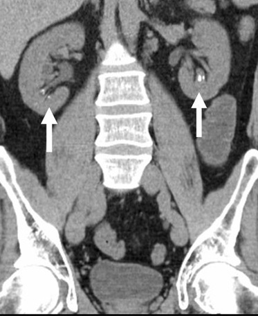 Litiasis renal