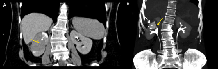 Carcinoma urotelial de la vía excretora superior