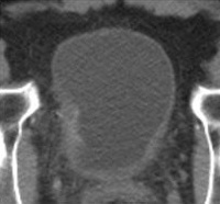 Tumor vesical