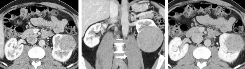 Carcinoma de células renales