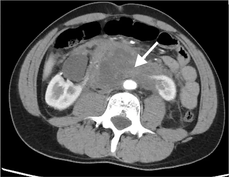 Tomografía axial con contraste de un riñón en herradura cuyos polos inferiores se unen por delante de la aorta; la flecha señala una lesión traumática del istmo.