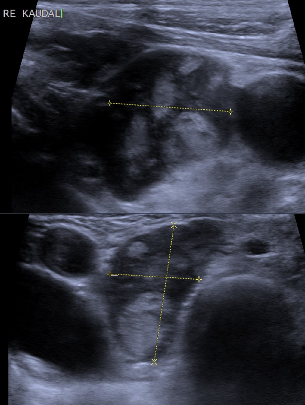 Adenoma paratiroideo