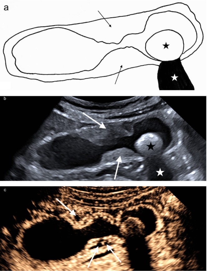 Adenomiomatosis vesicular