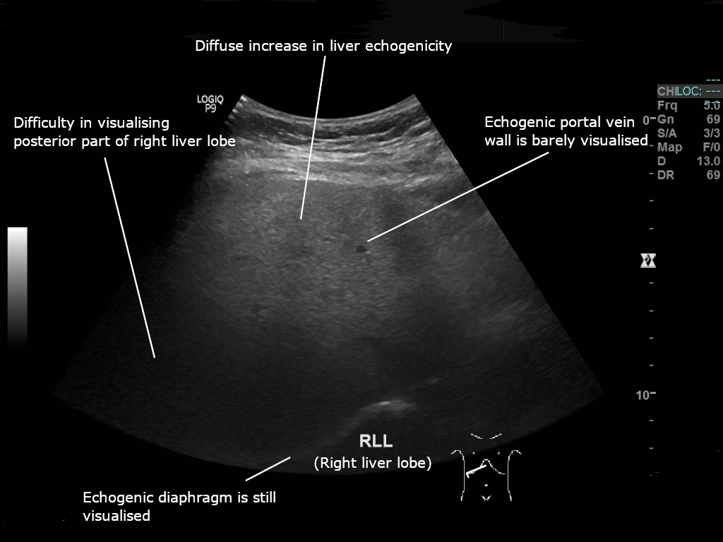 Esteatosis hepática