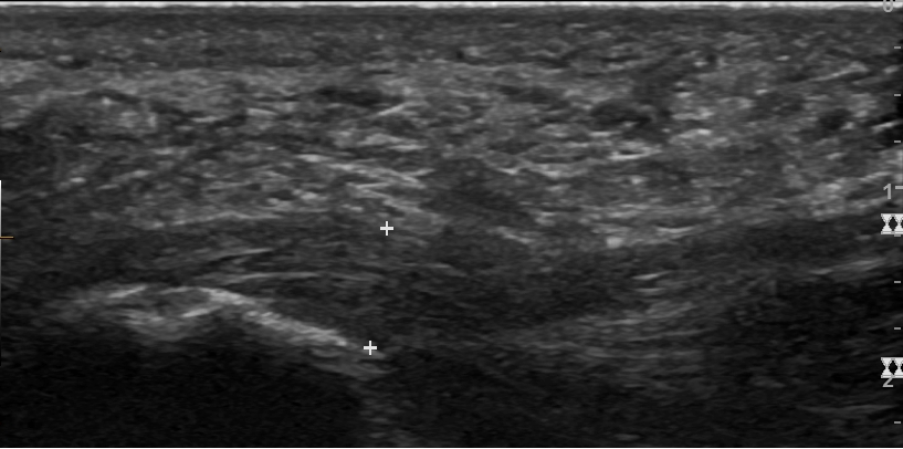 Fascitis plantar