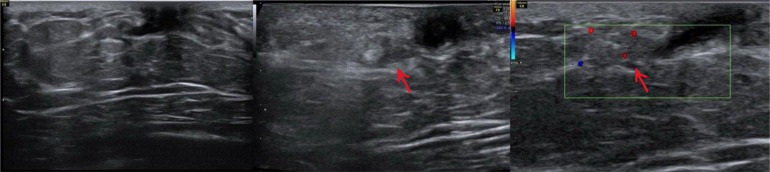 Papiloma intraductal