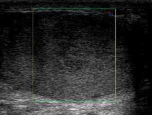 Torsión testicular